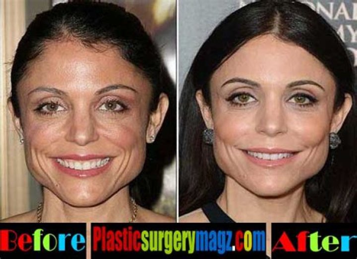 Here’s What Experts Think Bethenny Frankel Has Had Done to Her Face (EXCLUSIVE)