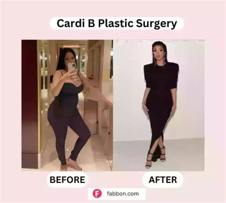 Cardi B Explains Why She Was So Open About Getting Lipo: ‘It Is Just Such a Long, Hard Process’