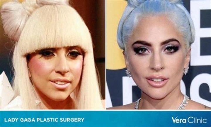 Did Lady Gaga Get Plastic Surgery? Everything the Singer-Actress Has Admitted to Over the Years
