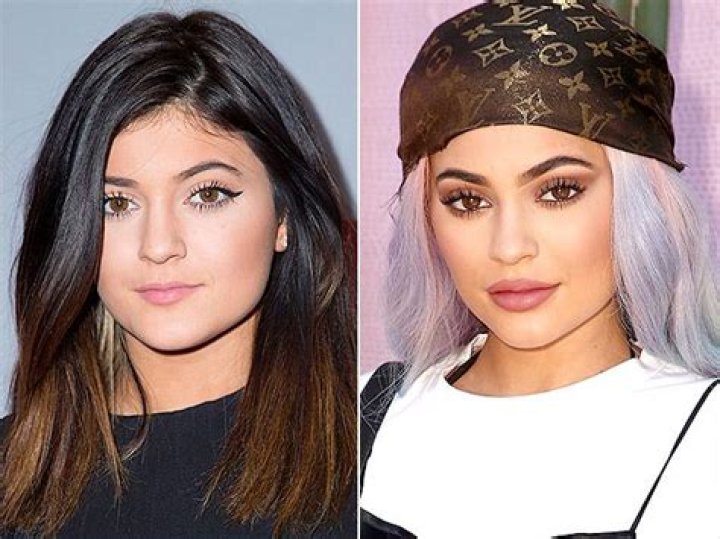Kylie Jenner’s Doctor Praises Her “Amazing Metamorphosis” — See How Much Her Face Has Changed!
