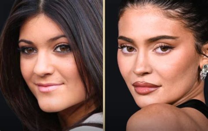 Kylie Jenner’s Lip Fillers On Full Display in Latest Instagram Pic — Check Out Her Crazy Transformation in 9 Clicks!