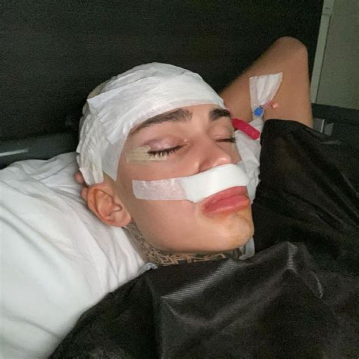 TikTok Star Levi Jed Murphy Underwent 5 Cosmetic Procedures in 1 Day: Before and After Photos