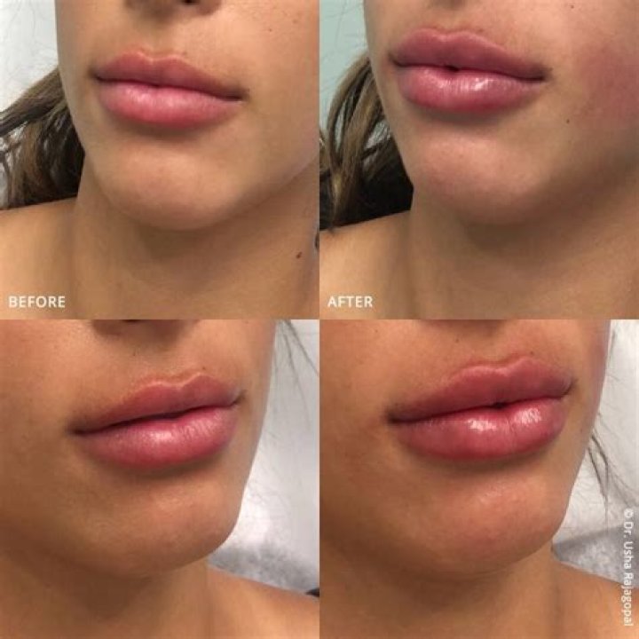 Lip Injections: 10 Things to Know Before Getting Fillers, According to Experts