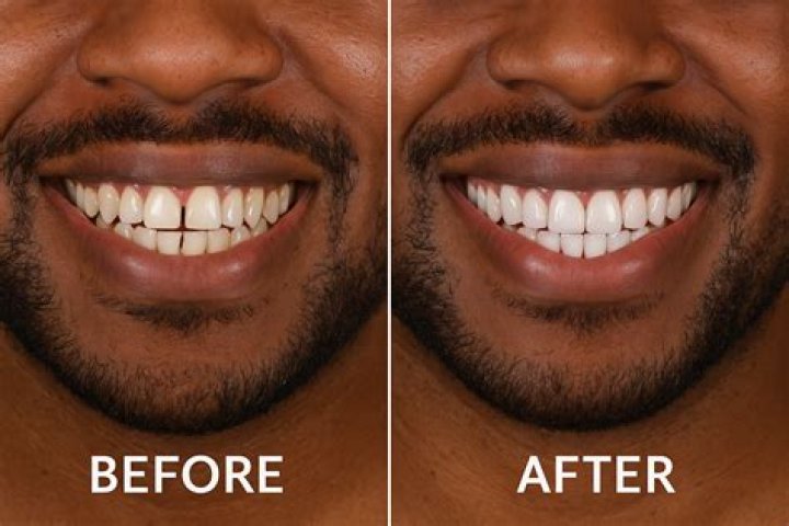 Matt Rife Teeth Before and After Veneers Photos Are Adorable