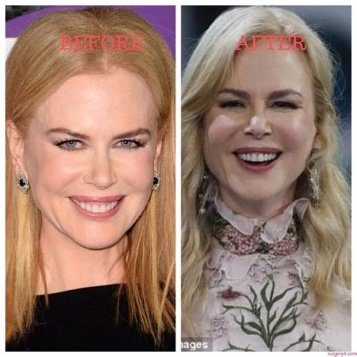 Nicole Kidman Sparks Plastic Surgery Rumors With Noticeably Swollen Face!
