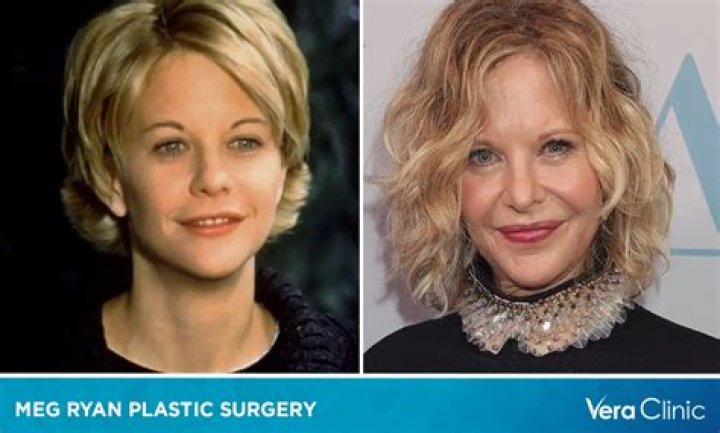 Did Meg Ryan Get Plastic Surgery? Photos of Her Dramatic Transformation Over the Years