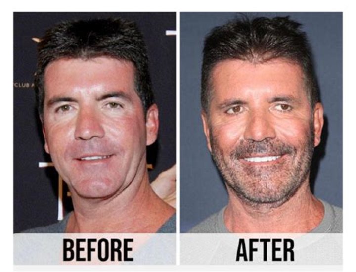 Simon Cowell Sparks Plastic Surgery Rumors on ‘AGT’ — Experts Weigh In (EXCLUSIVE)