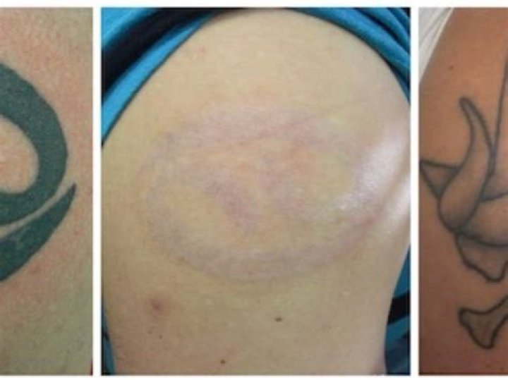 Student Left With Horrific Scar After Tattoo Removal Goes Painfully Wrong (WARNING: Graphic Images)