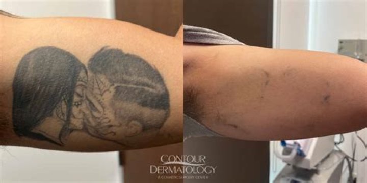 Skin Check-In With Dr. Will: 10 Things You Need to Know Before Getting a Tattoo Removed