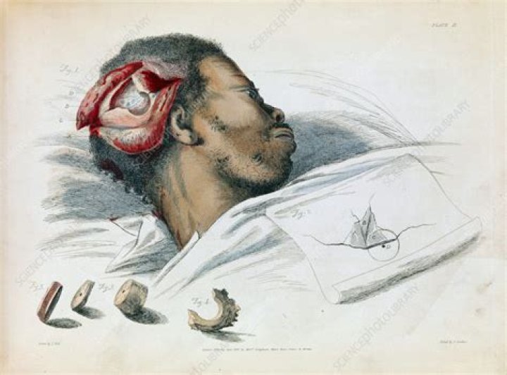 Trepanation Was The Bizarre Cure-All That Exposed Your Brain