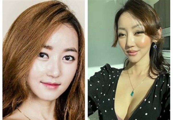 Truth About Yeonmi Park’s Surgery Rumors