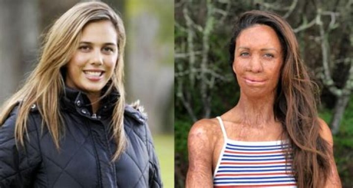 What Did Turia Pitt Look Like Before Accident? Everything To Know About Her Story