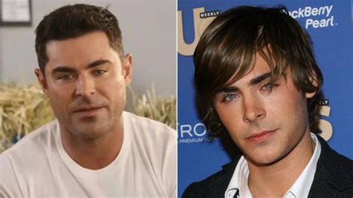 What Happened To Zac Efron Face After Car Accident: Jaw Injury Update, Before & After Plastic Surgery